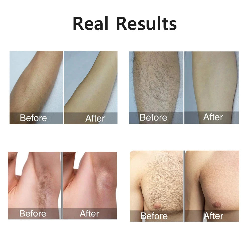 Depiladora láser para mujer, depilación indolora para axila, Bikini, cuerpo, pierna, brazo, 990000 Flashes