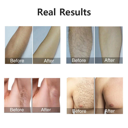 Depiladora láser para mujer, depilación indolora para axila, Bikini, cuerpo, pierna, brazo, 990000 Flashes